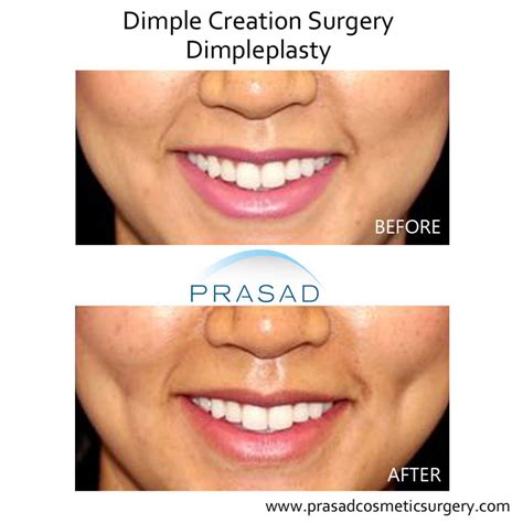 plastic surgery dimple creation